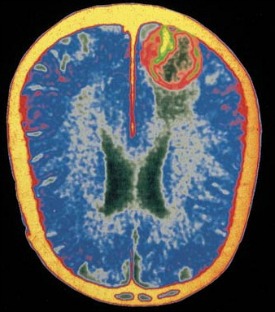 Brain with encephalitis